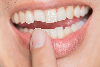 Close-up of a cracked front tooth being pointed at, highlighting dental trauma or damage.